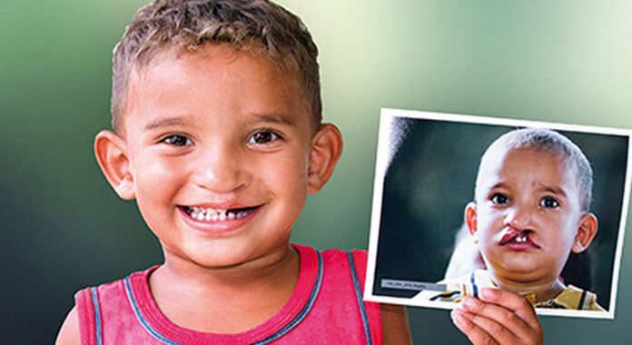 Opération Smile Morocco: Ils ont encore sauvé 100 sourires d’enfants !